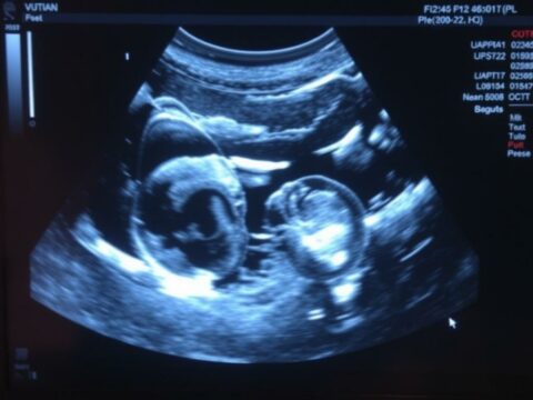 УЗИ яичников: что именно смотрят врачи, как подготовиться и как не испугаться результата